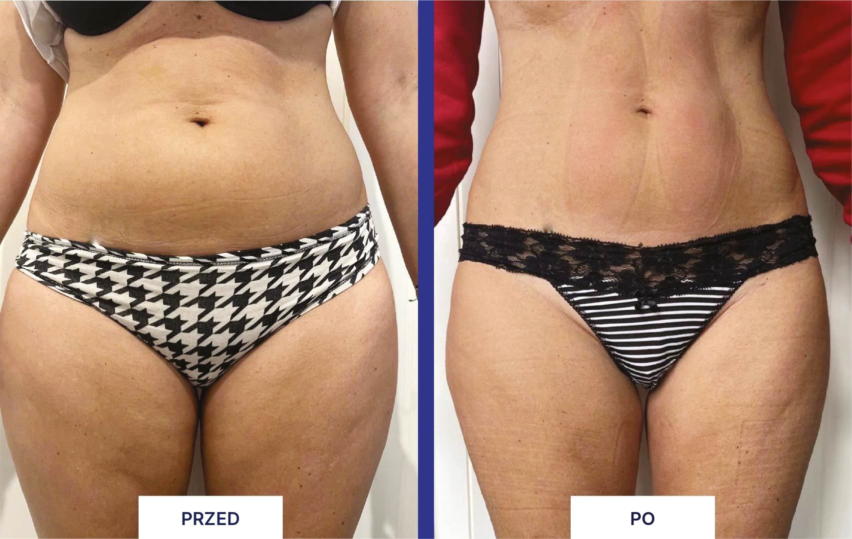 MYA 40 przed i po zabiegu - brzuch i biodra