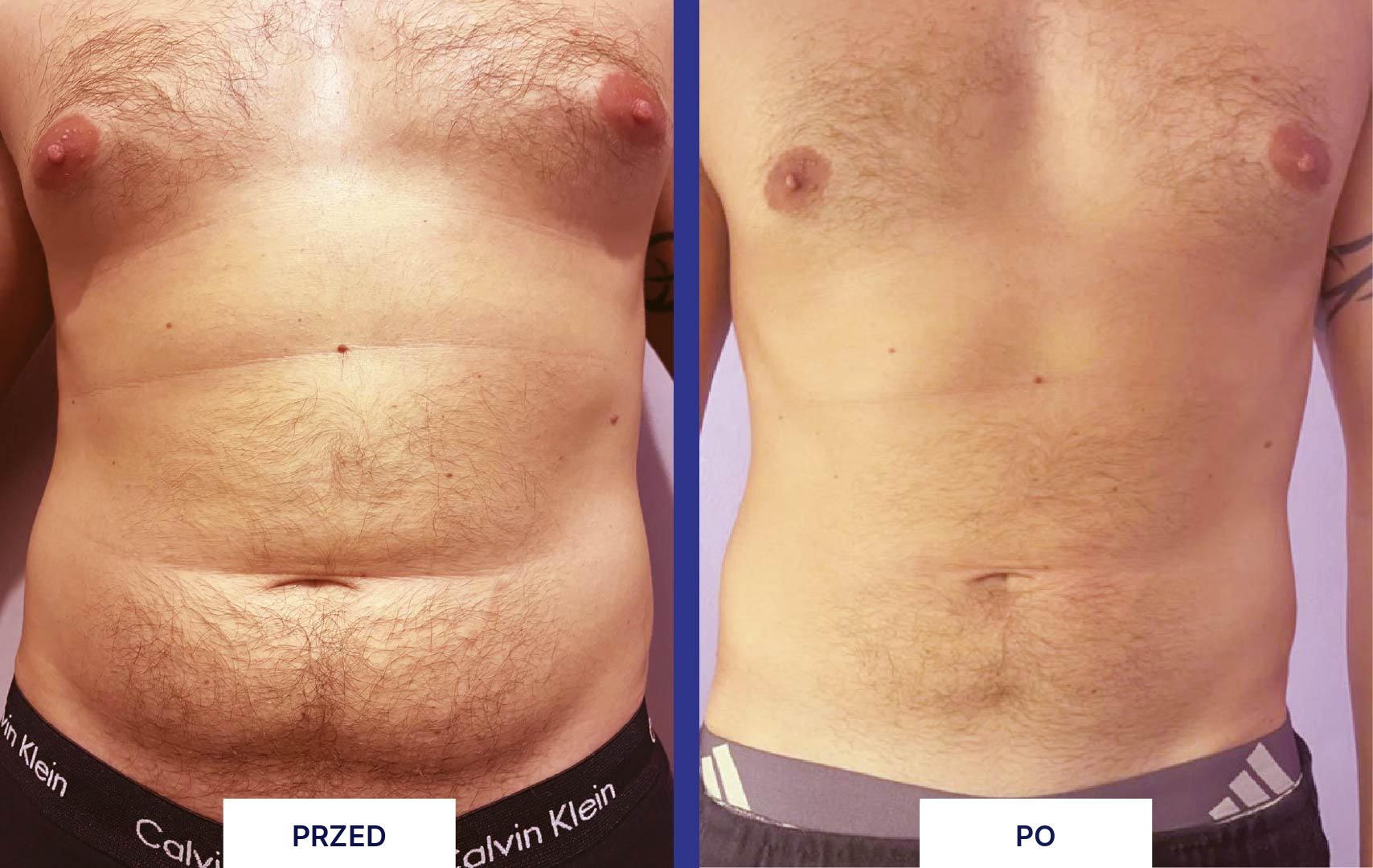 MYA 40 przed i po zabiegu - brzuch męski