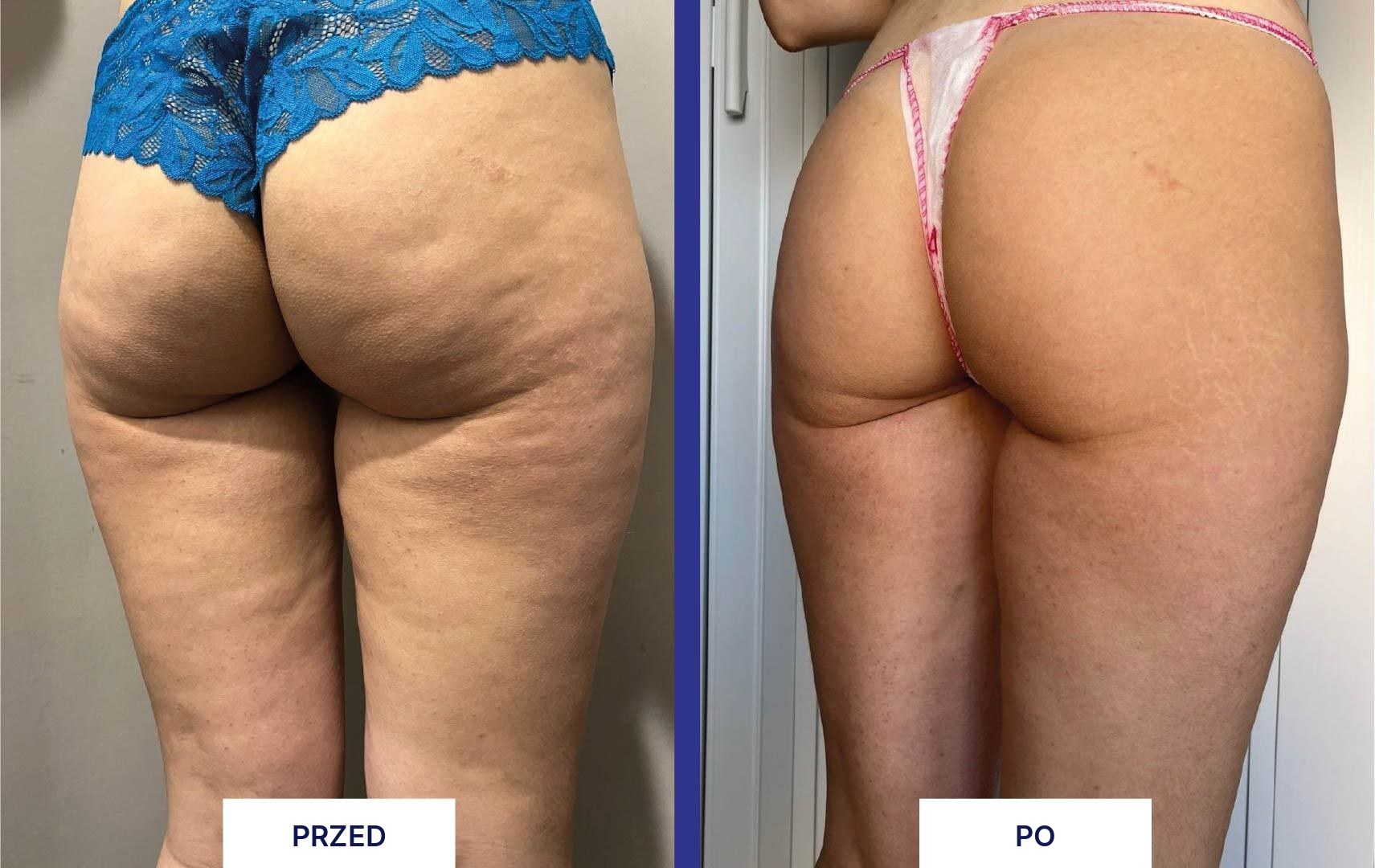 MYA 40 przed i po zabiegu - pośladki i uda